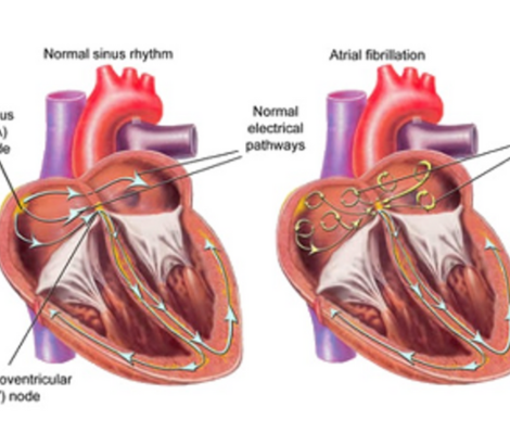 cross-section of the heart indicating electrical impulses which cause it to beat