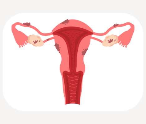 diagram illustrating endometriosis